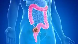 Científicos argentinos desarrollaron un virus que ataca el cáncer colorrectal y sus células resistentes