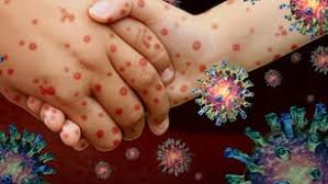 Alerta en Entre Ríos por posible exposición de pasajeros al sarampión