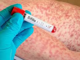 La sífilis superó los 55 mil casos en el último año en Argentina