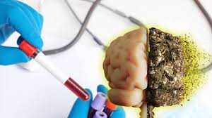 Un análisis de sangre permite detectar el Alzheimer antes que los métodos tradicionales