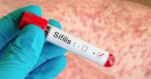 Más de 46.000 casos de Sífilis en 2025