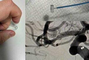 Inédita intervención endovascular en el Hospital “San Martín” de La Plata